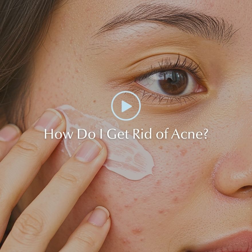 Teen girl with acne on cheeks and forehead demonstrating the need for effective acne treatment and skincare routine