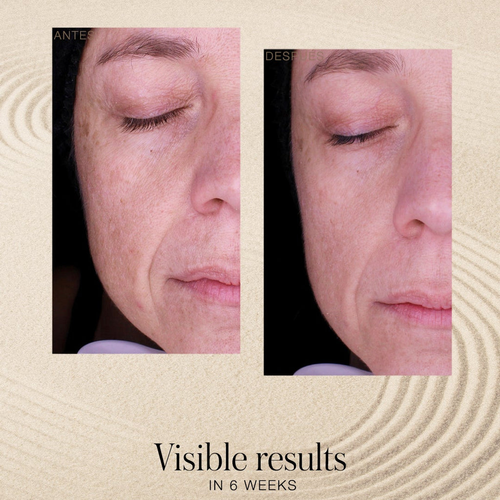 Before and after comparison of a person's face with text indicating visible results in 6 weeks.