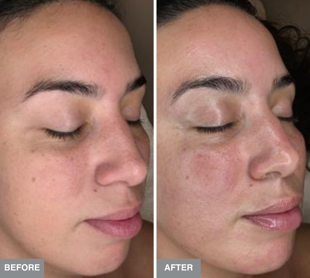 Before day 0 and after day 14 close-up eye area comparison