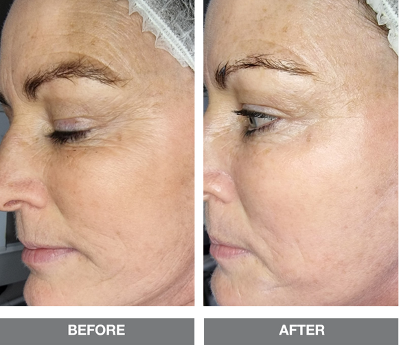 COLLAGEN THREAD TIGHTENING FACIAL SOLUTION