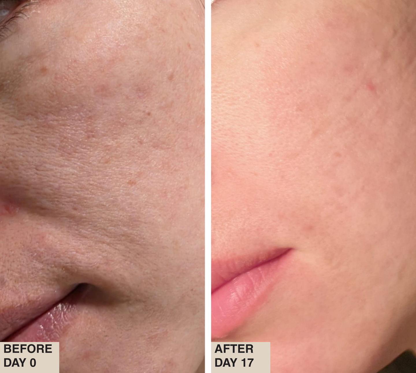 Before day 0 and after day 14 close-up eye area comparison